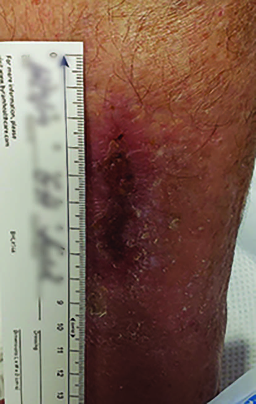 This photo illustrates near complete healing 11 weeks after evacuation, CTP application and compression therapy.