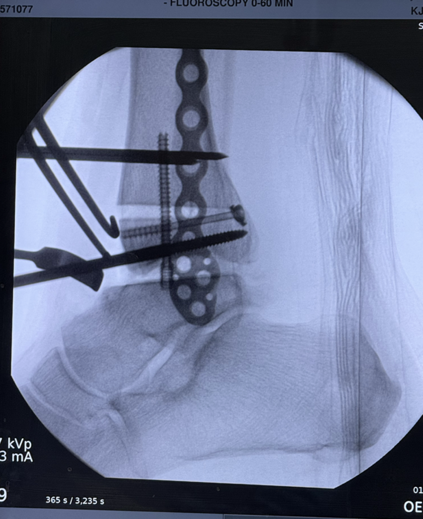 Figure 3. Intraoperative radiograph