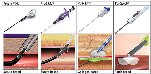 Fig. 1. Representative examples of suture-based, collagen plug-based, and patch-based vascular access site closure devices