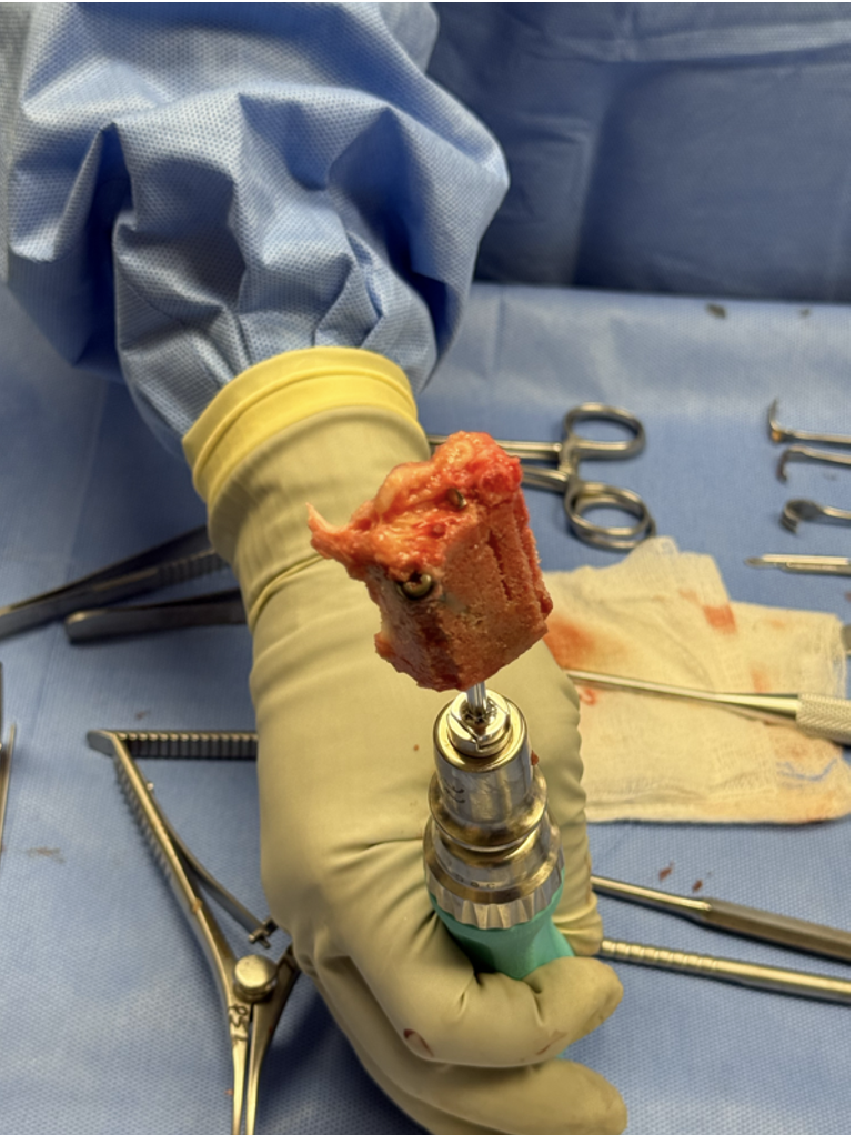  Figure 4. Intraoperative radiograph, screw retrieval in bone&nbsp;