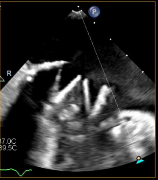 Figure 5A. Transesophageal echocardiogram