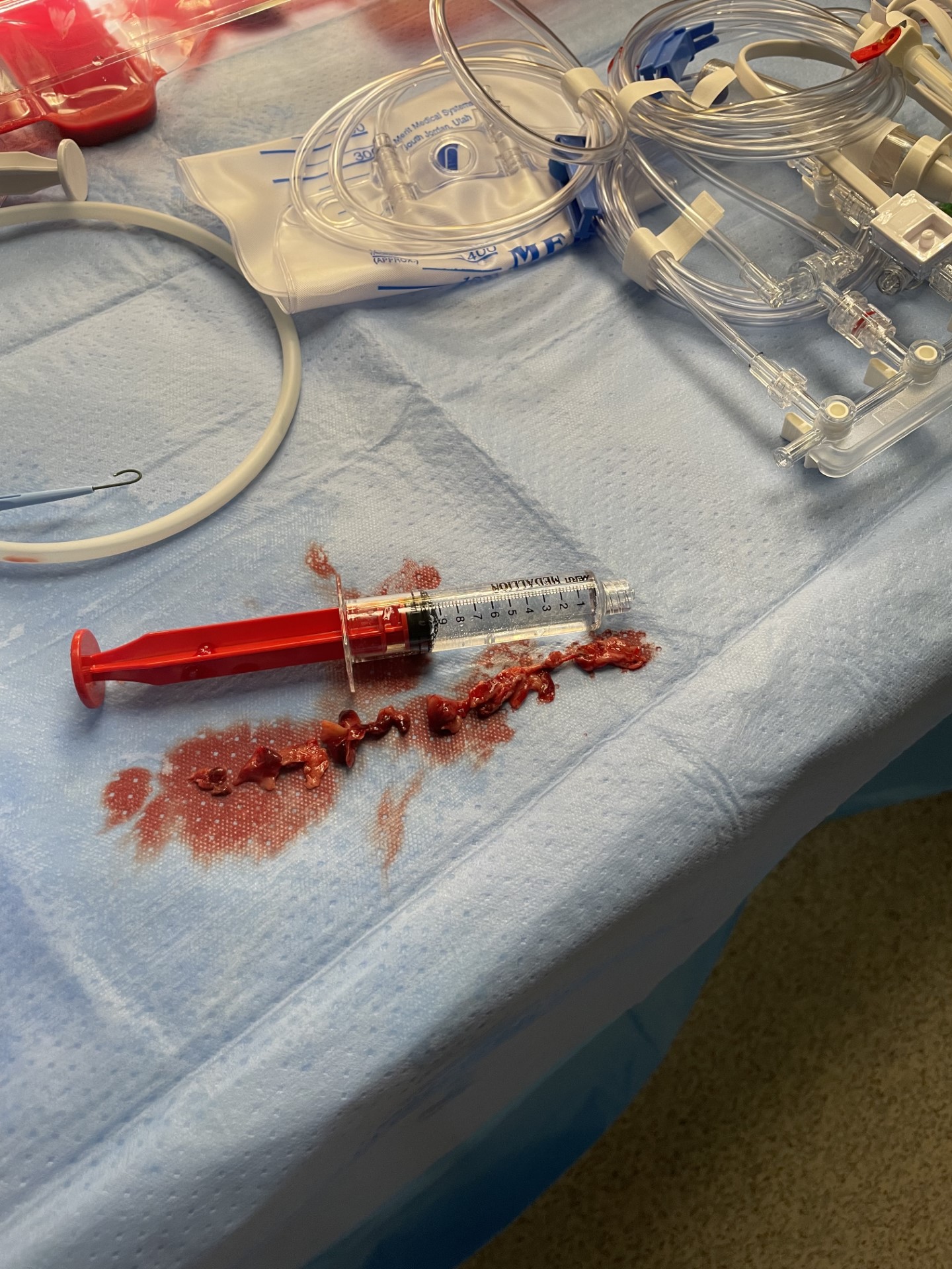 Figure 5B. Visualization of the large thrombus burden