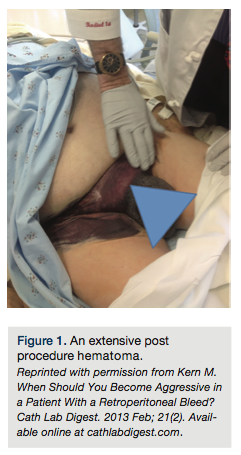 An extensive post procedure hematoma