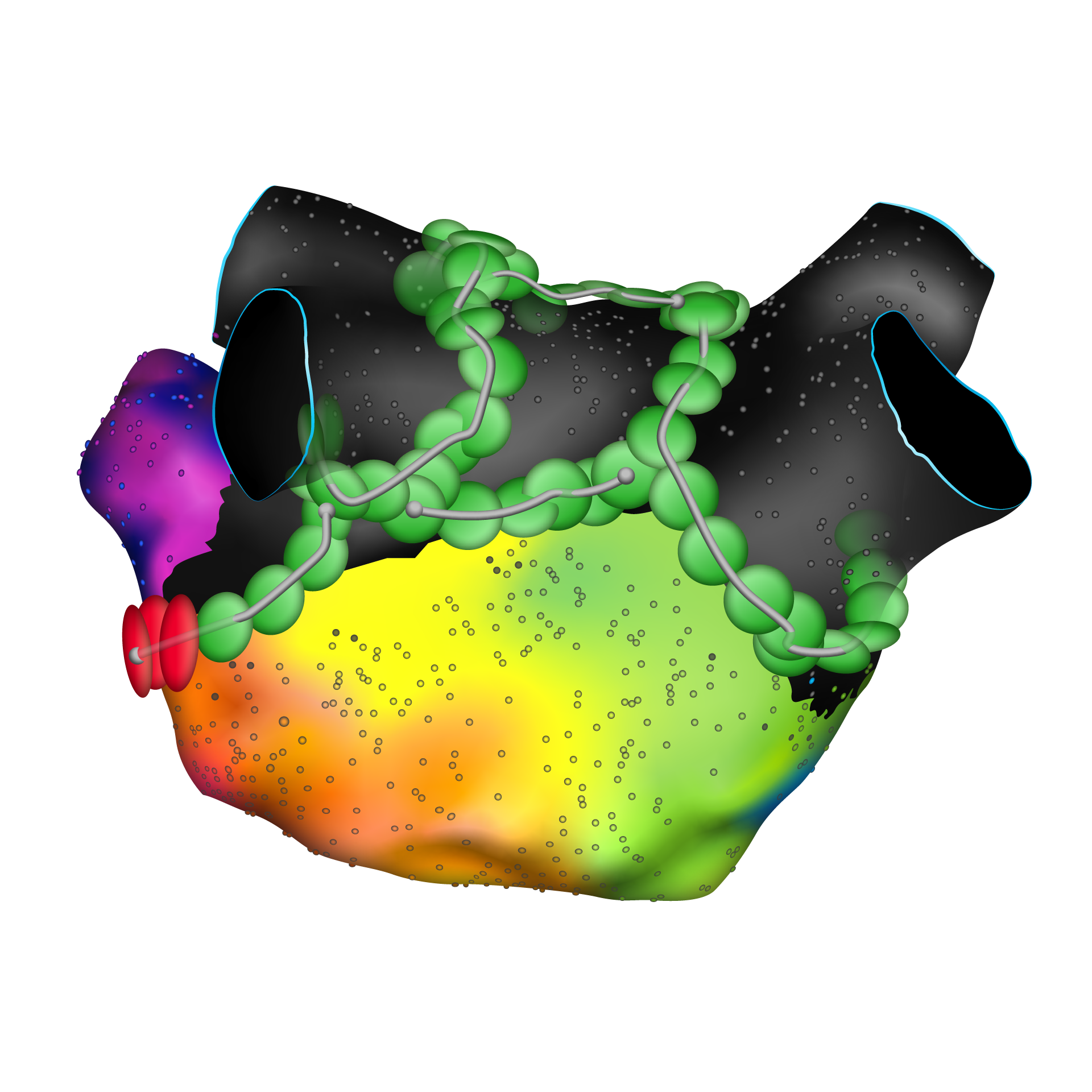 Figure 2. &nbsp;Affera™ mapping and ablation system (Medtronic). &nbsp;