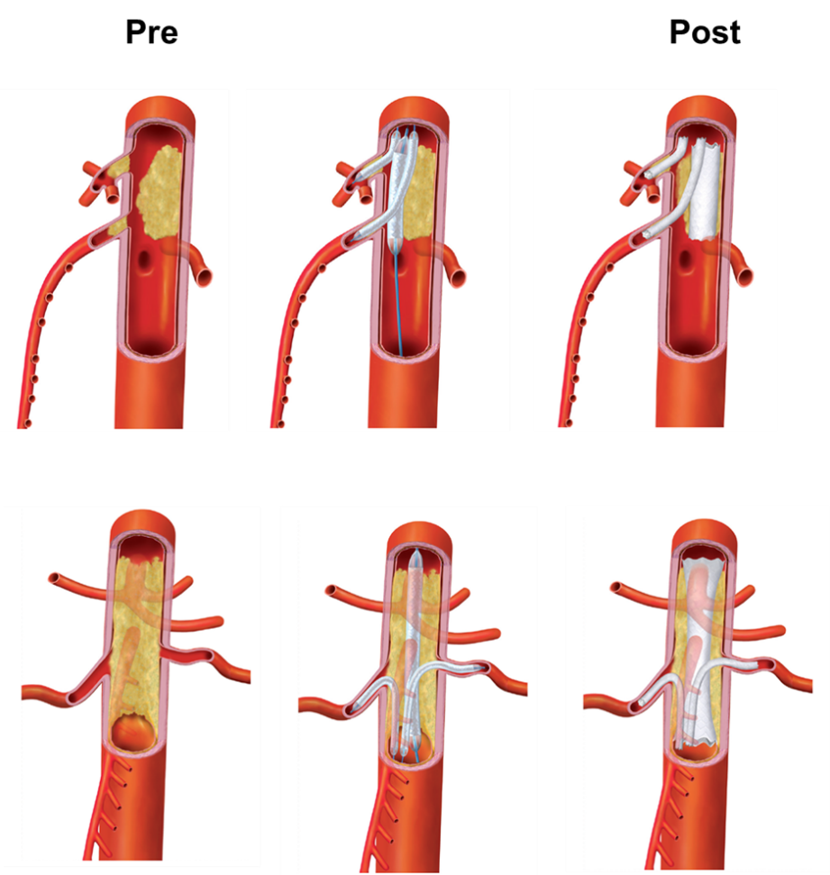 Fig 1. Illustrations of aorta and visceral artery interventions
