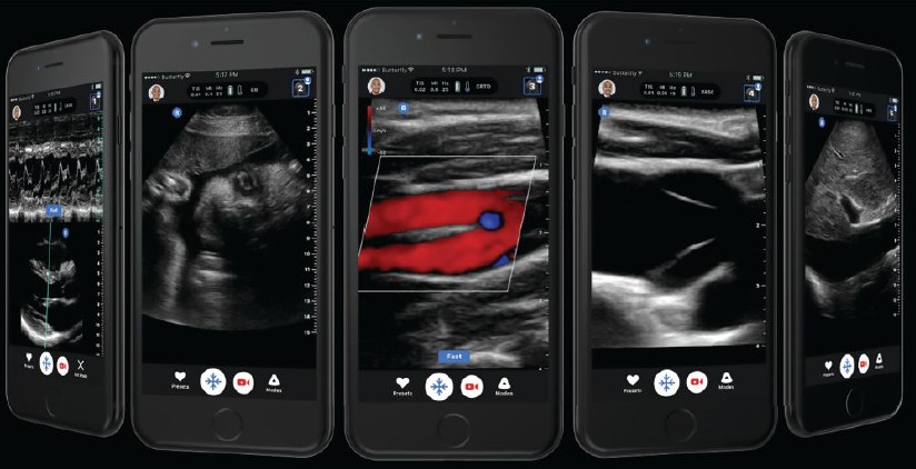 The Butterfly iQ+ has a variety of clinical applications that span the entire body, including the detection of hidden trauma like pneumothorax and the presence of occult blood in the abdomen. (Photo: Butterfly Network) 