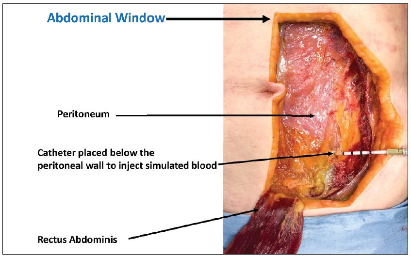Figure 1: An abdominal window was created to show the effects of hidden abdominal trauma and associated hemorrhage. Here you can see the adipose, rectus abdominus, and internal oblique muscle. The external oblique muscle was removed. (Photo: Centre for Emergency Health Services) 