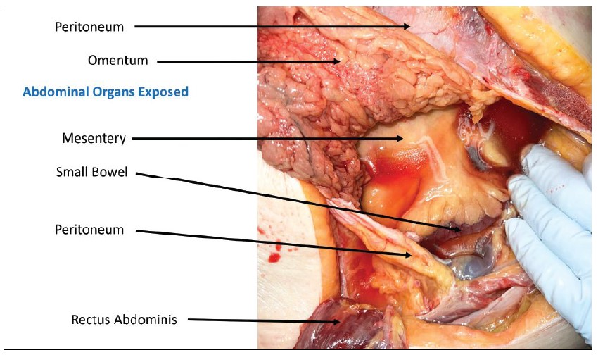 Figure 2: The abdominal window with the muscles reflected (rectus placed caudal), the peritoneum open, and the omentum, the fold of peritoneum connecting the stomach with other abdominal organs, manually reflected cephalad and, to the right, with mesentery and small bowel exposed. (Photo: Centre for Emergency Health Services) 