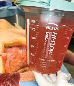 Figure 3: The container shows 1000 ml (2.2 units) of free fluid that was placed into the abdomen via a catheter into the abdominal cavity just beneath the peritoneal wall. Note that there’s no abdominal distention seen until more than 1000 ml was infused. (Photo: Centre for Emergency Health Services) 
