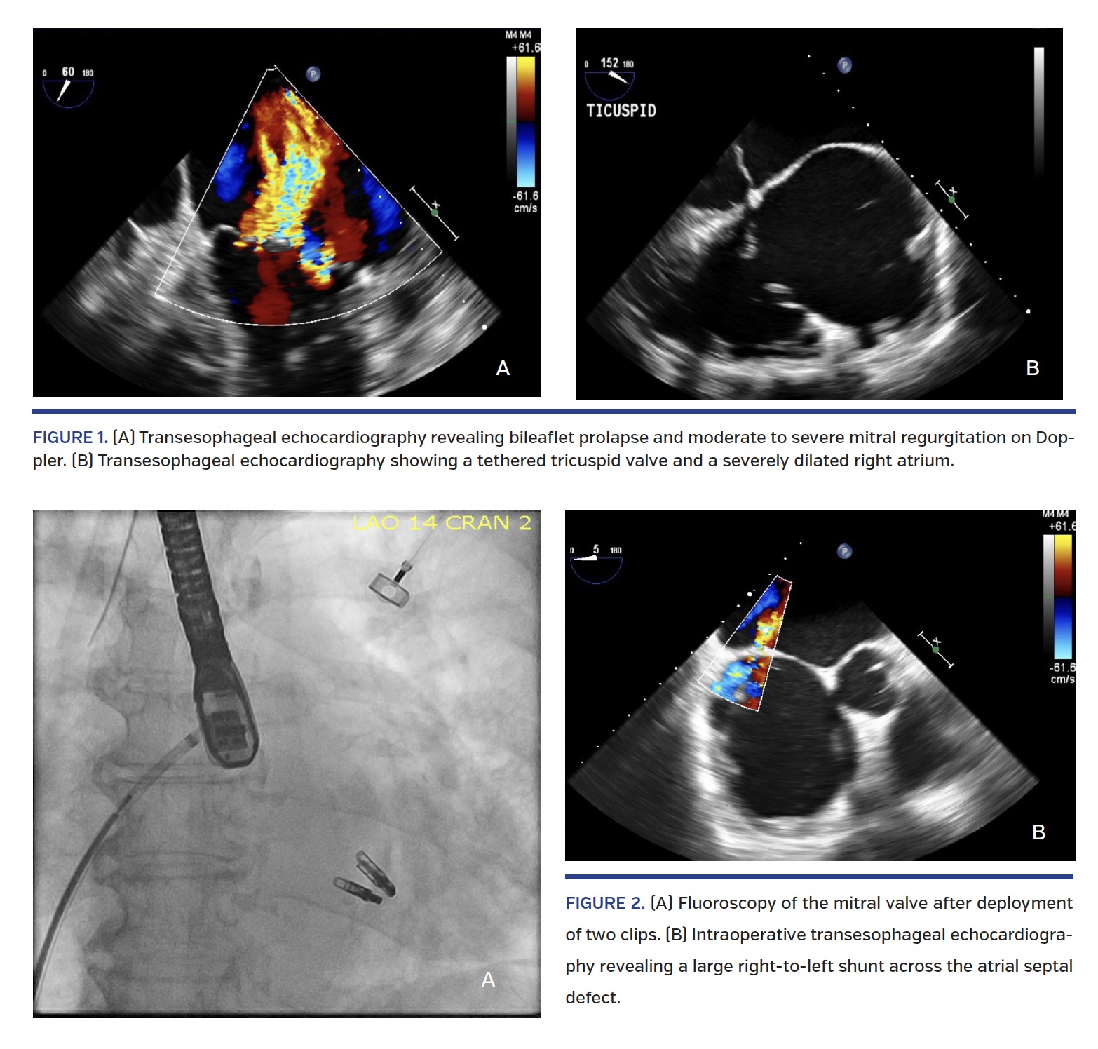 ASD Closure After MitraClip Repair