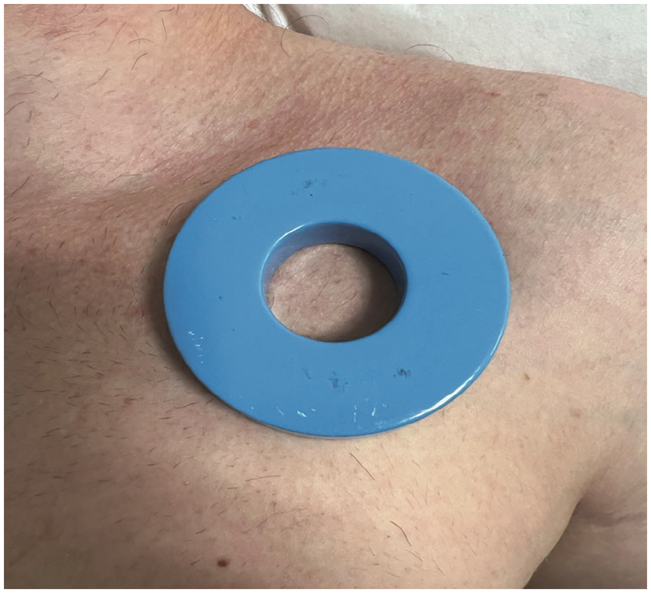 Aabye Pacemaker Figure 2