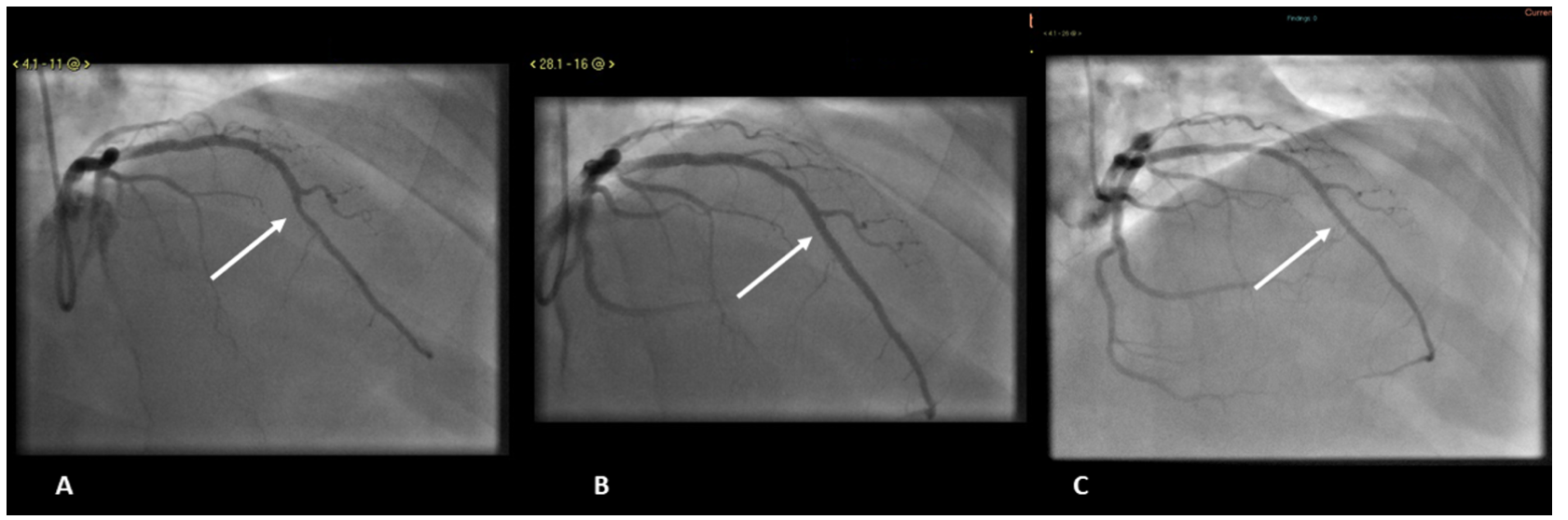 Abdalwahab Myocardial Muscle Bridges Figure 2