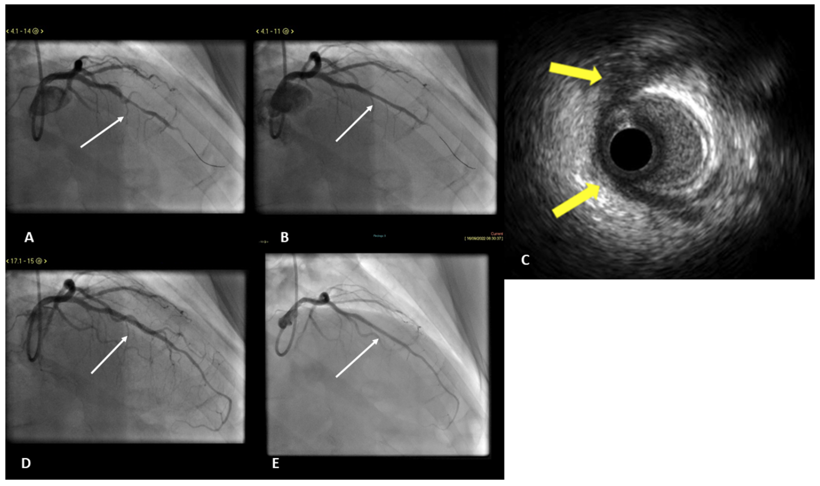 Abdalwahab Myocardial Muscle Bridges Figure 4