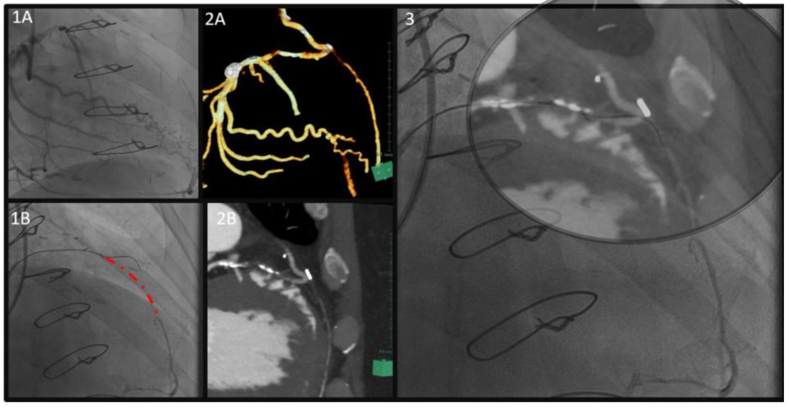 Abdelwahed Coronary Artery Tenting Figure 1-3