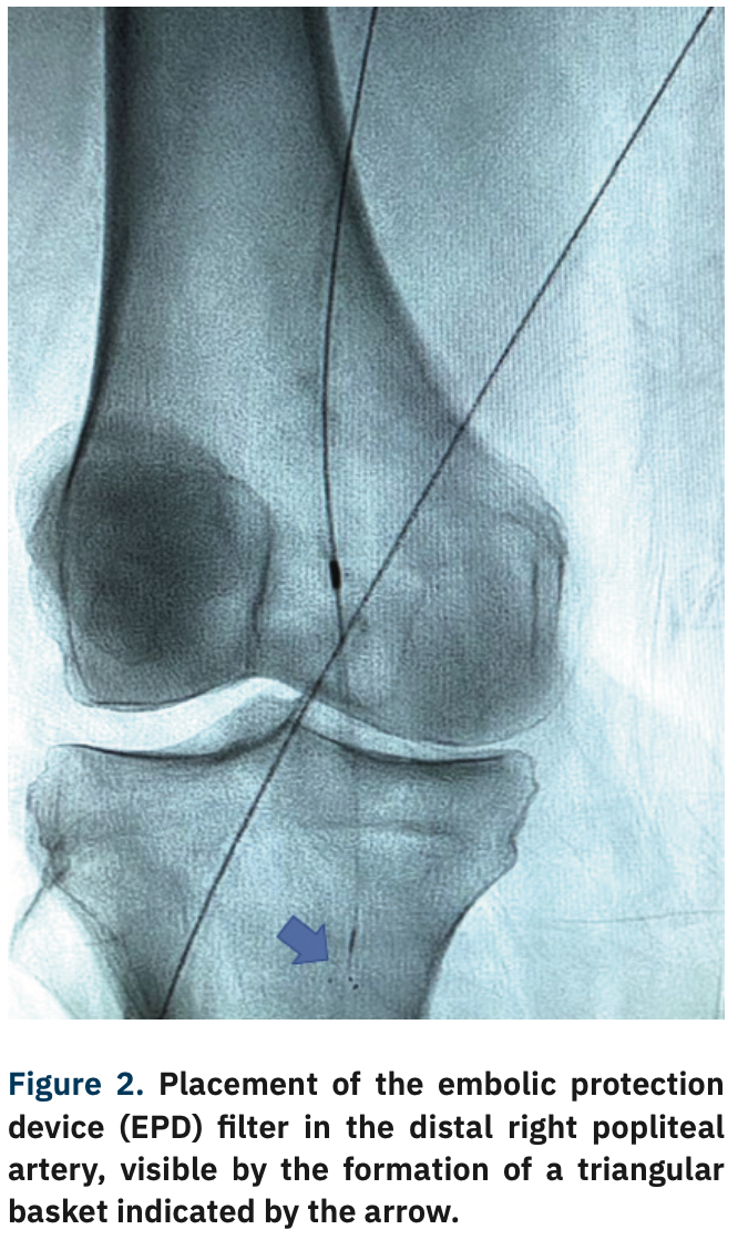 Adams Thrombotic Occlusions Figure 2