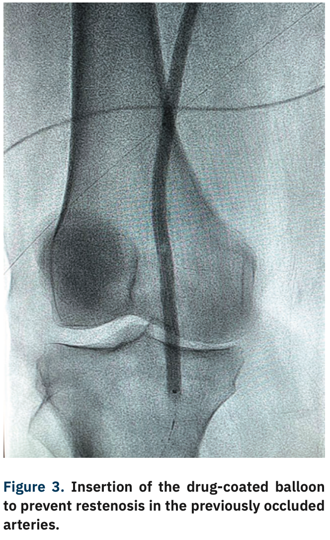Adams Thrombotic Occlusions Figure 3