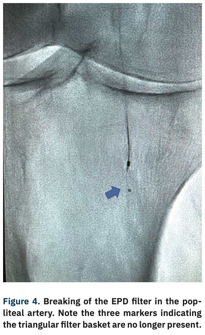 Adams Thrombotic Occlusions Figure 4