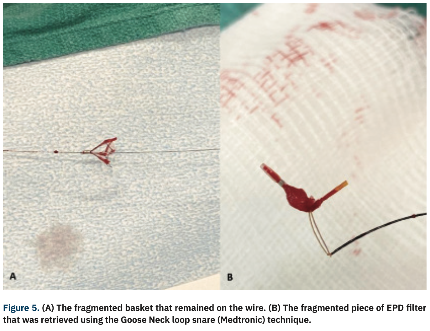 Adams Thrombotic Occlusions Figure 5