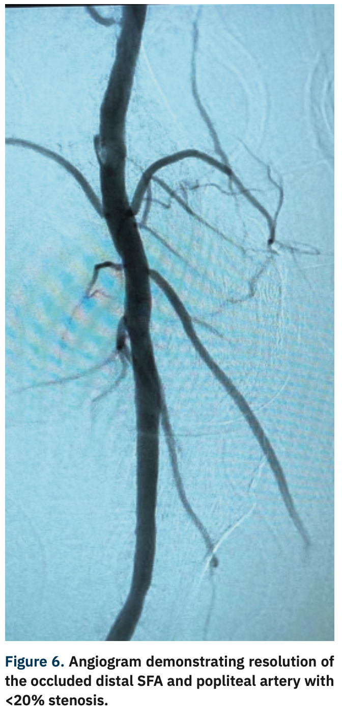 Adams Thrombotic Occlusions Figure 6