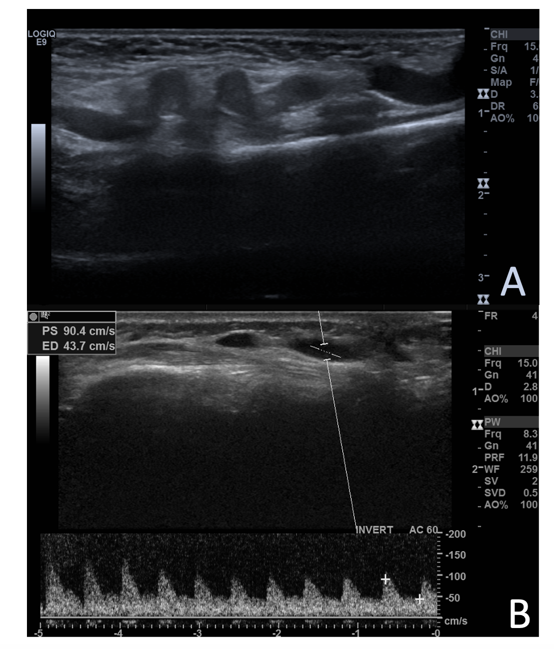 Figure 1. (A,B) Color Doppler ultrasonography of the right wrist revealed a large communication channel between the radial artery and the cephalic vein at the level of the antecubital fossa. There was turbulent blood flow. The artery was markedly enlarged.