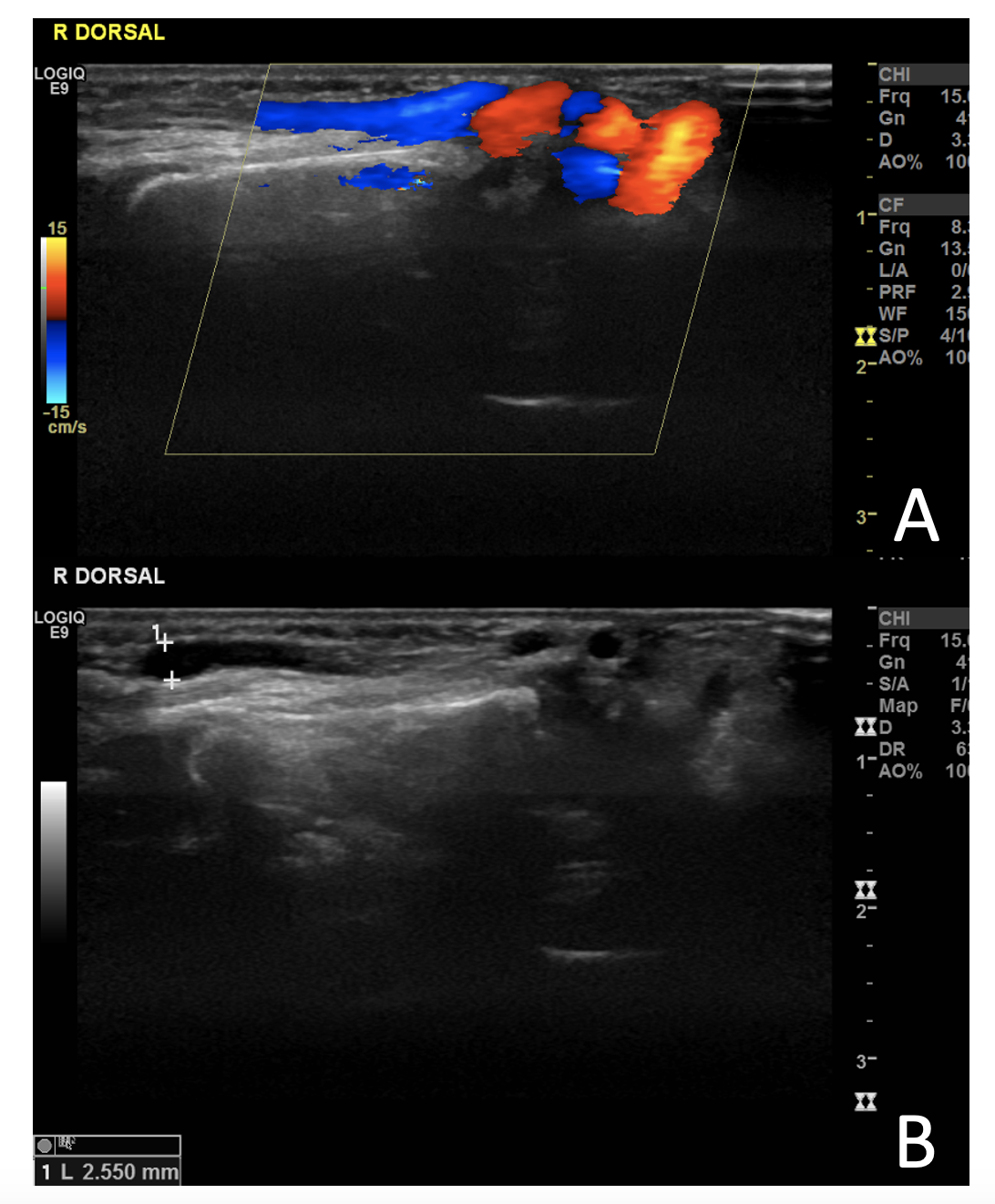 Figure 2. (A) Color Doppler showing the characteristic yin-yang flow within the arteriovenous fistula. (B) The artery was markedly enlarged with an internal diameter of 2.55 mm.