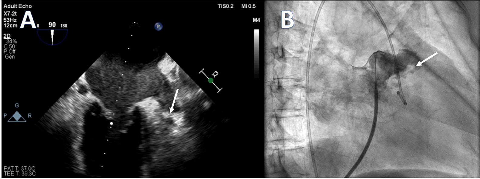 Figure. (A) Mid-esophageal transesophageal view