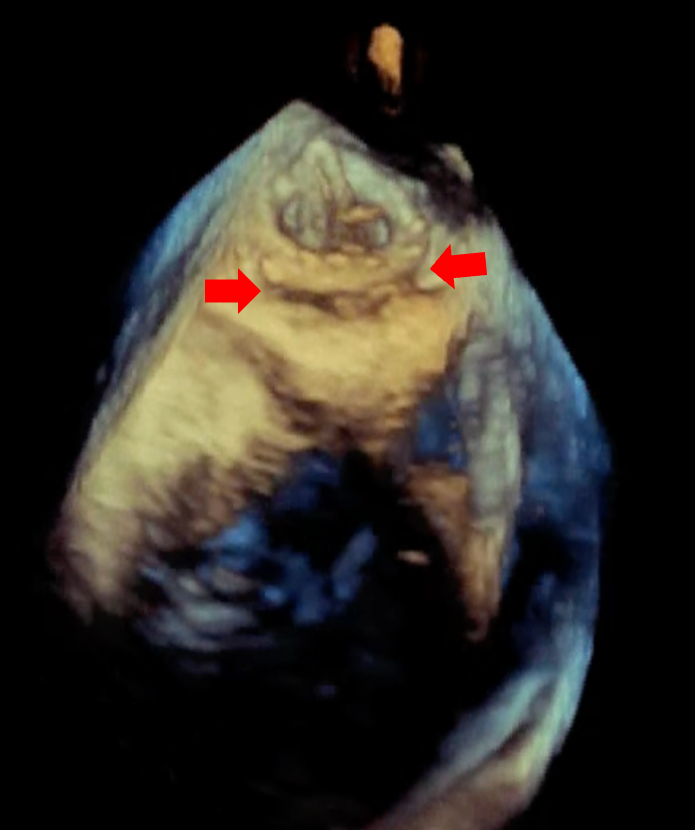Figure 1. Three-dimensional transesophageal echocardiography