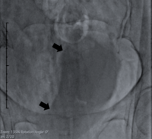 Figure. Bladder fluoroscopy 