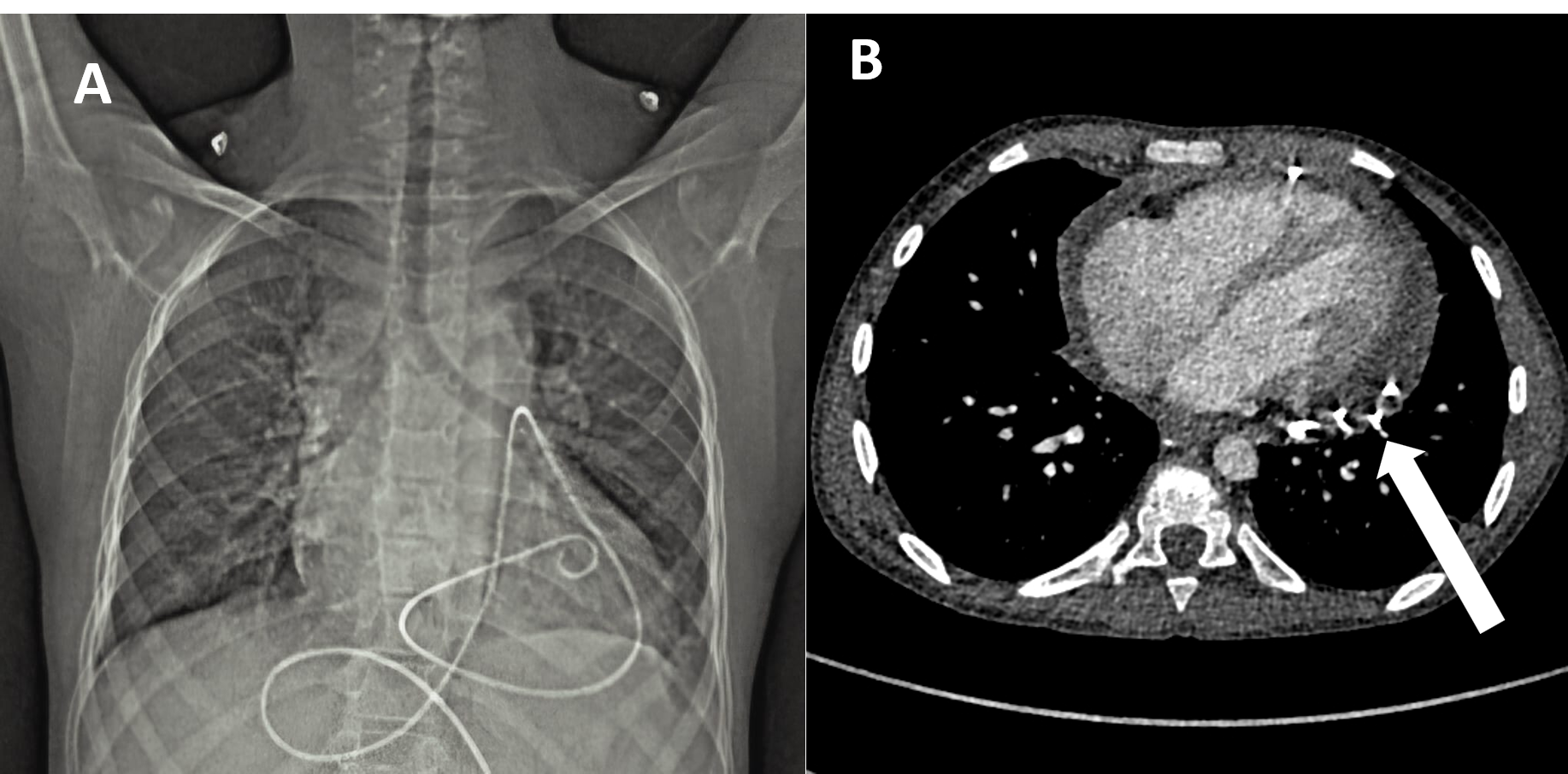 Figure 2. (A) Anterior-posterior view chest radiograph with the pigtail catheter 