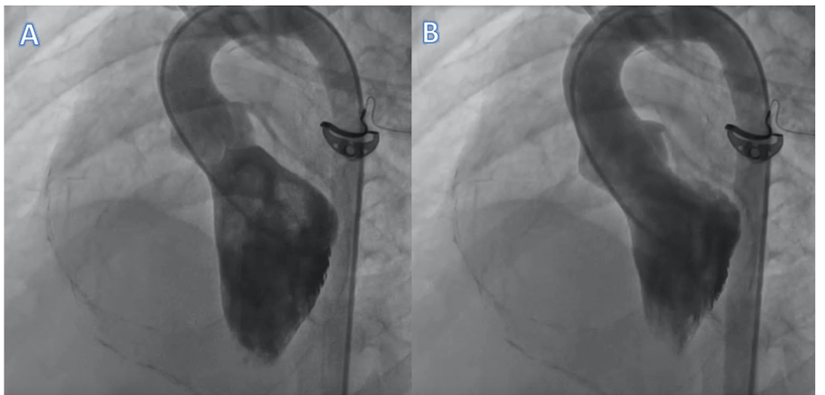 Ahmed Pericarditis Figure 1