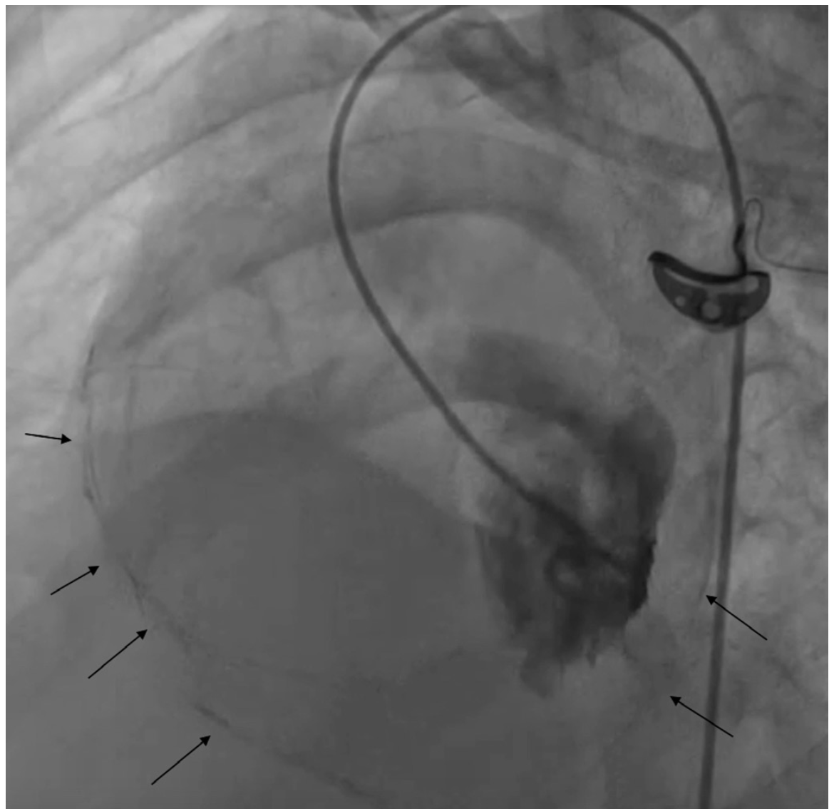 Ahmed Pericarditis Figure 2