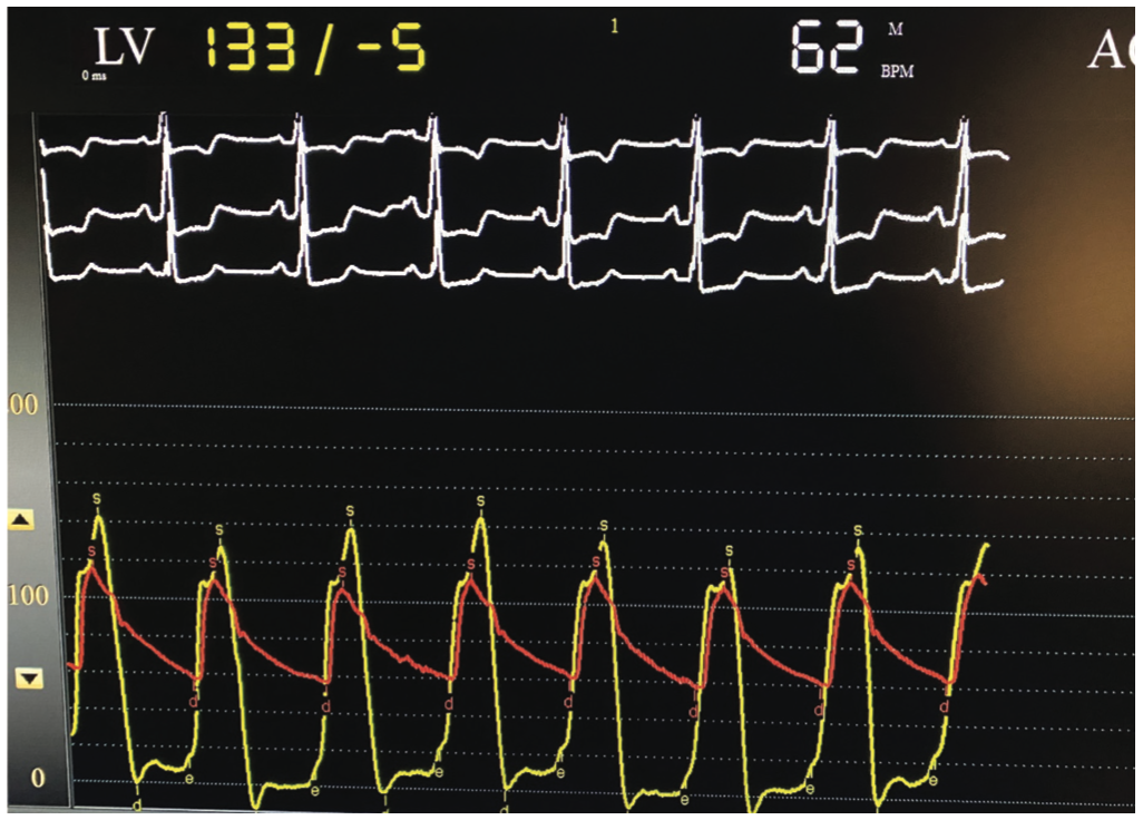Ajmal Aortic Pressure Gradient Figure 4