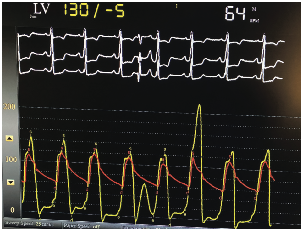 Ajmal Aortic Pressure Gradient Figure 5