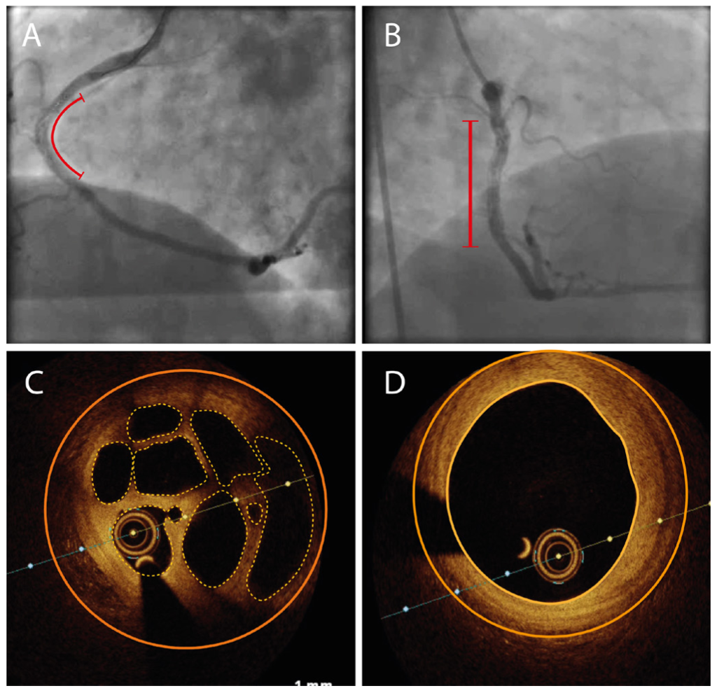 Akhtar Coronary Caverns Figure 1