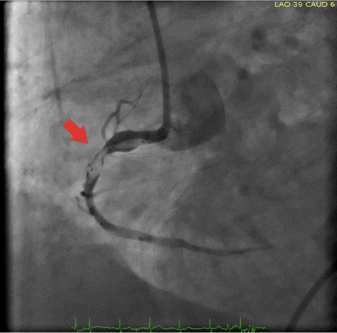 Akkus Balloon Shaft Fracture Fig 1