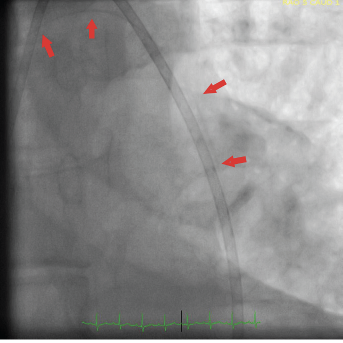 Akkus Balloon Shaft Fracture Fig 2