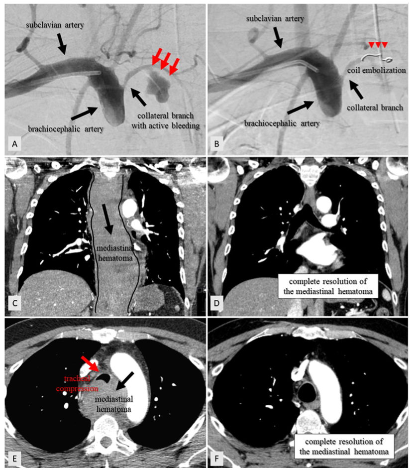 Alexandre Coil Embolization Figure 1