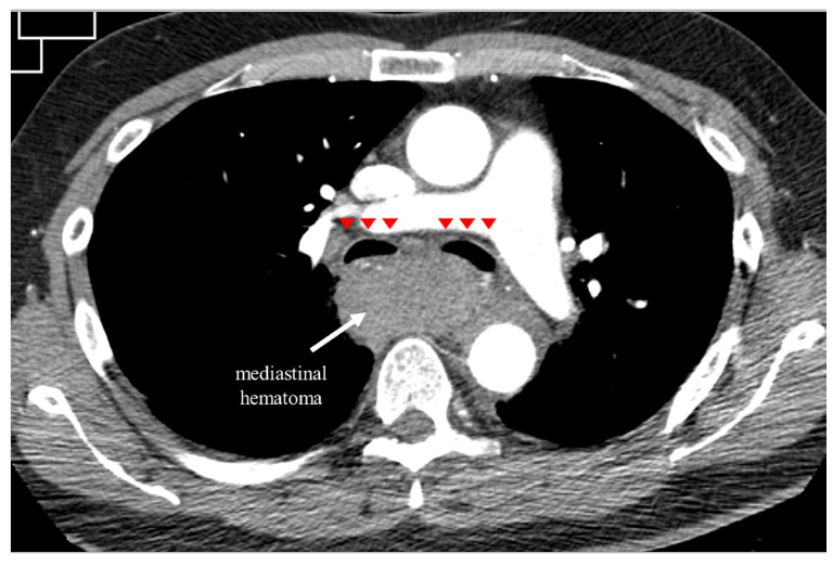 Alexandre Coil Embolization Figure 2