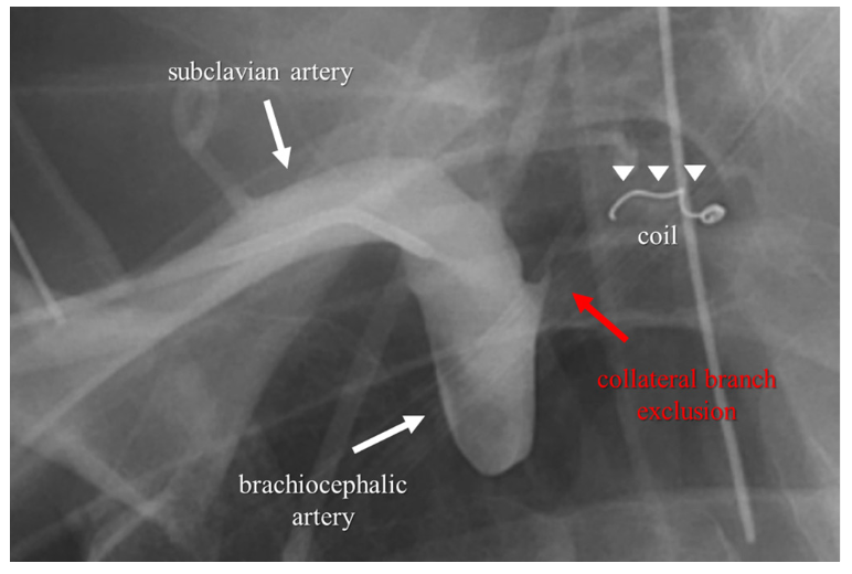 Alexandre Coil Embolization Figure 3