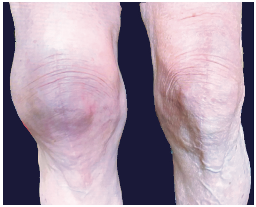 Ali-Bailey Coil Embolization Figure 1