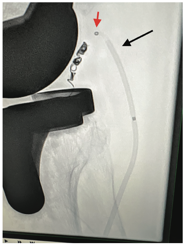 Ali-Bailey Coil Embolization Figure 3
