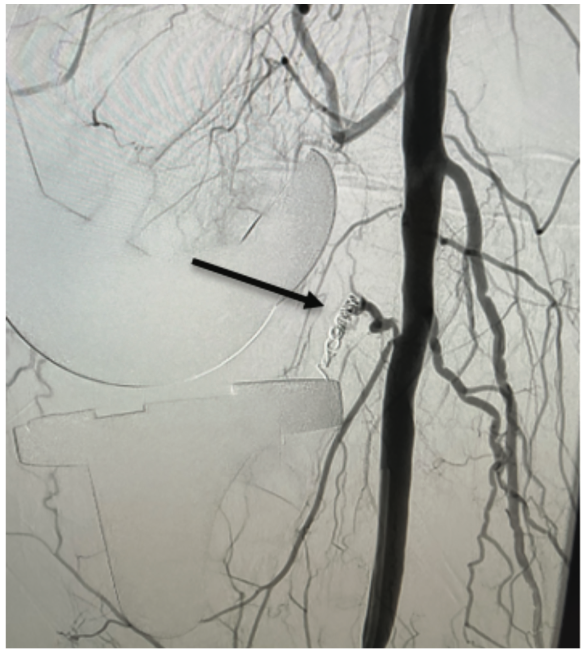 Ali-Bailey Coil Embolization Figure 4