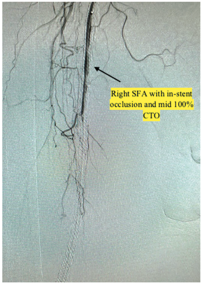 AliBailey Infrapopliteal Figure 2