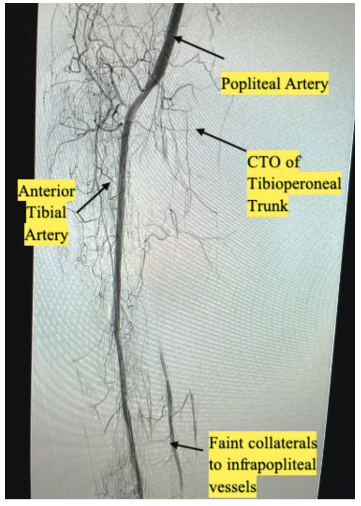 AliBailey Infrapopliteal Figure 3