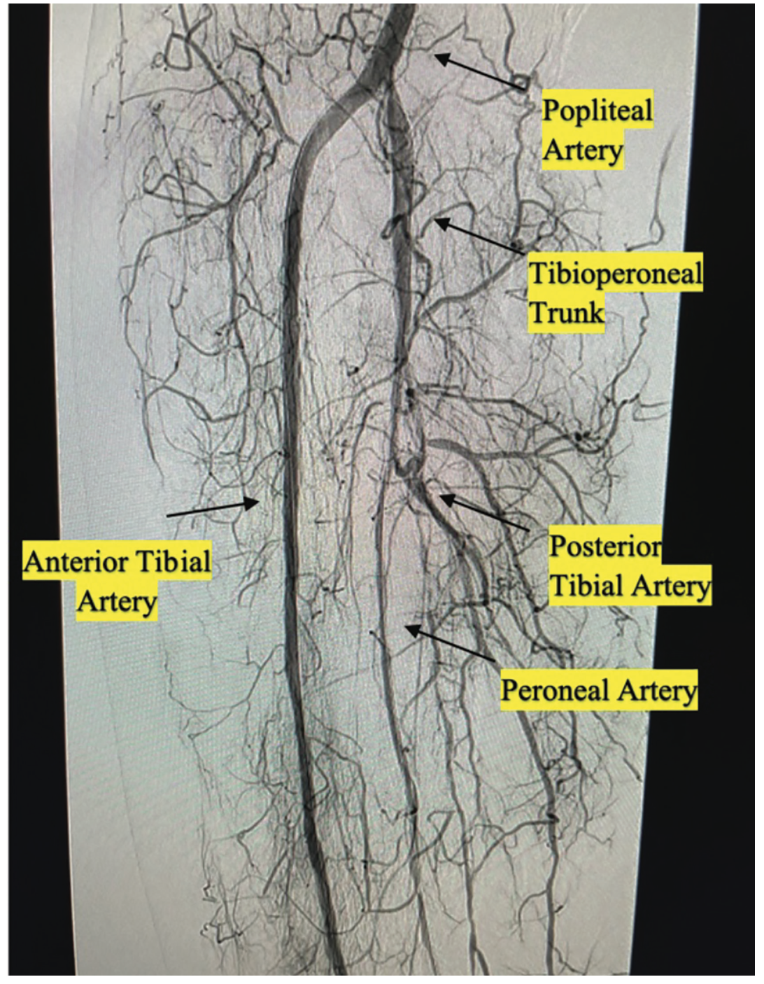 AliBailey Infrapopliteal Figure 6
