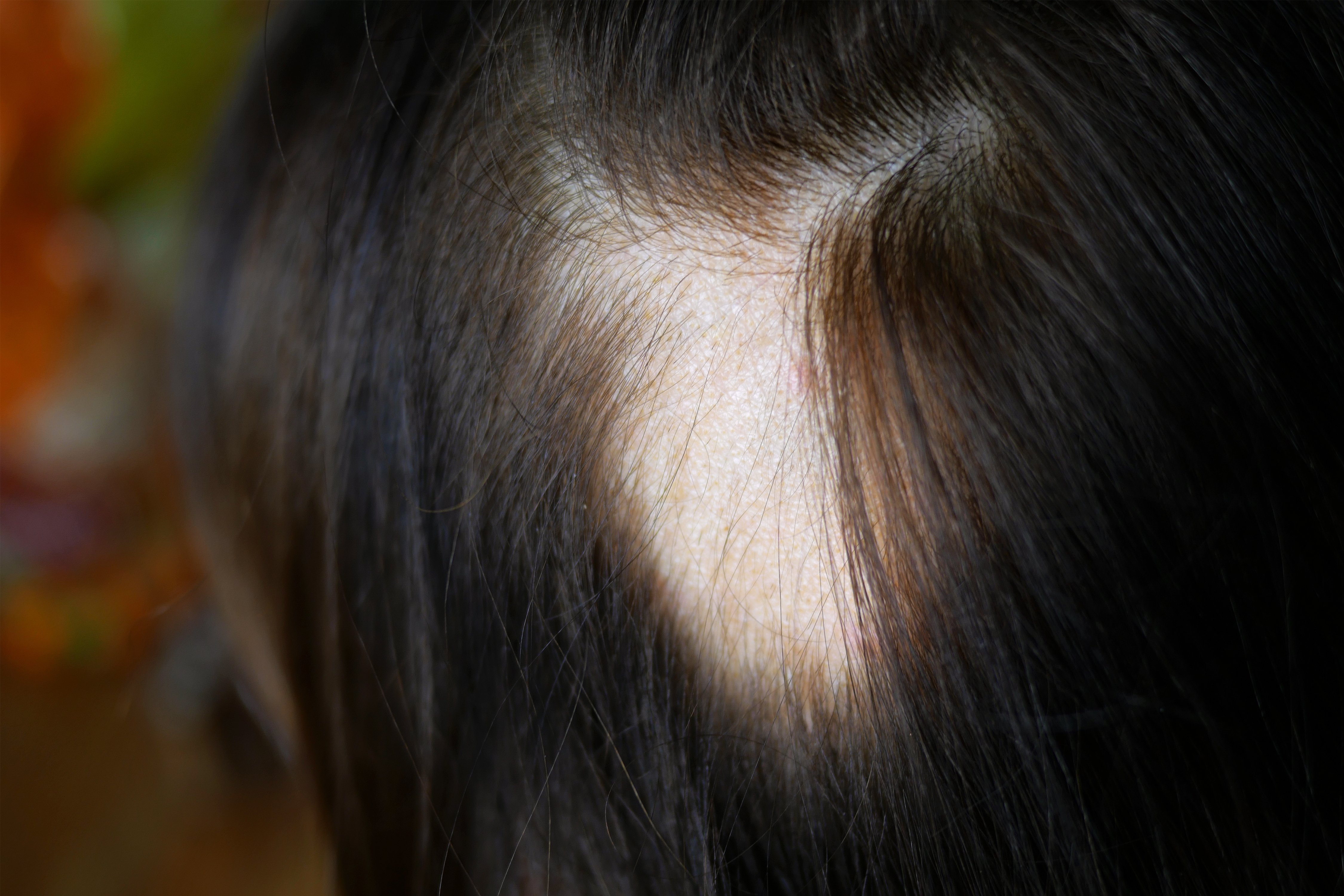 Alopecia
