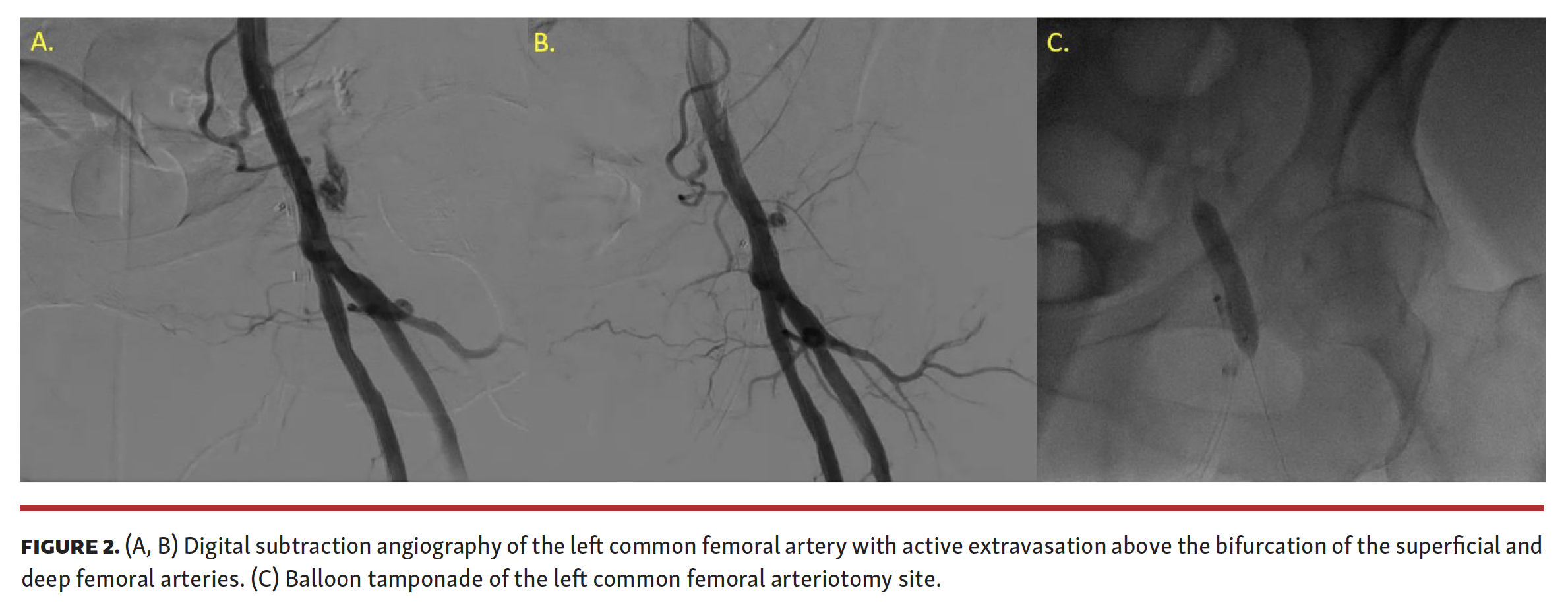 Alrayes Failed Manta Closure Device Fig 2