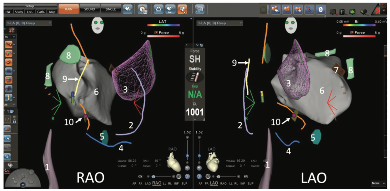 Alsheikh Catheter Ablation Figure 1