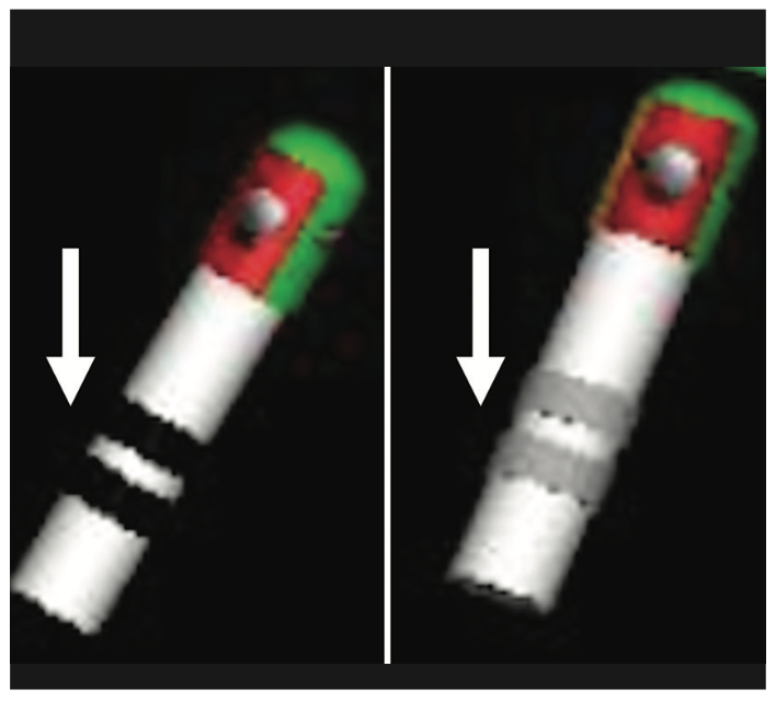 Alsheikh Catheter Ablation Figure 2