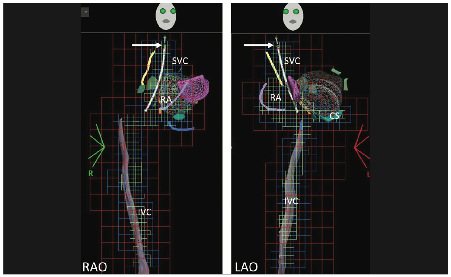 Alsheikh Catheter Ablation Figure 3